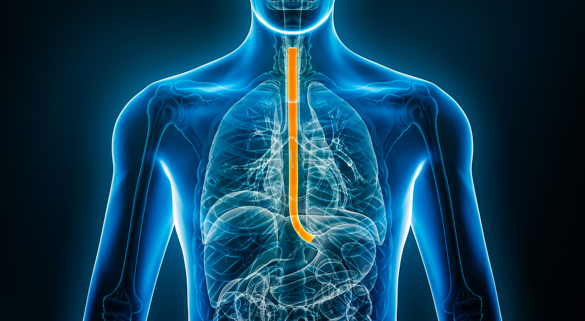 Cancer de l'oesophage
