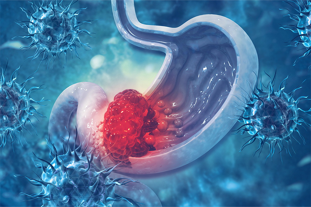 epidemiologie estomac