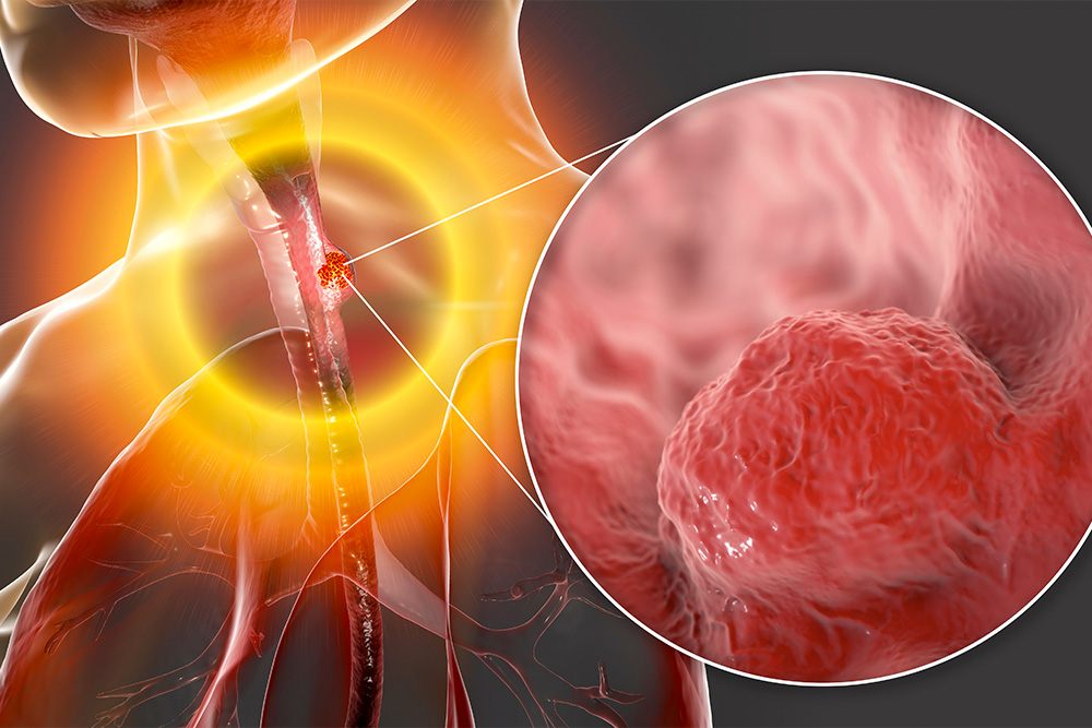 epidemiologie oesophage